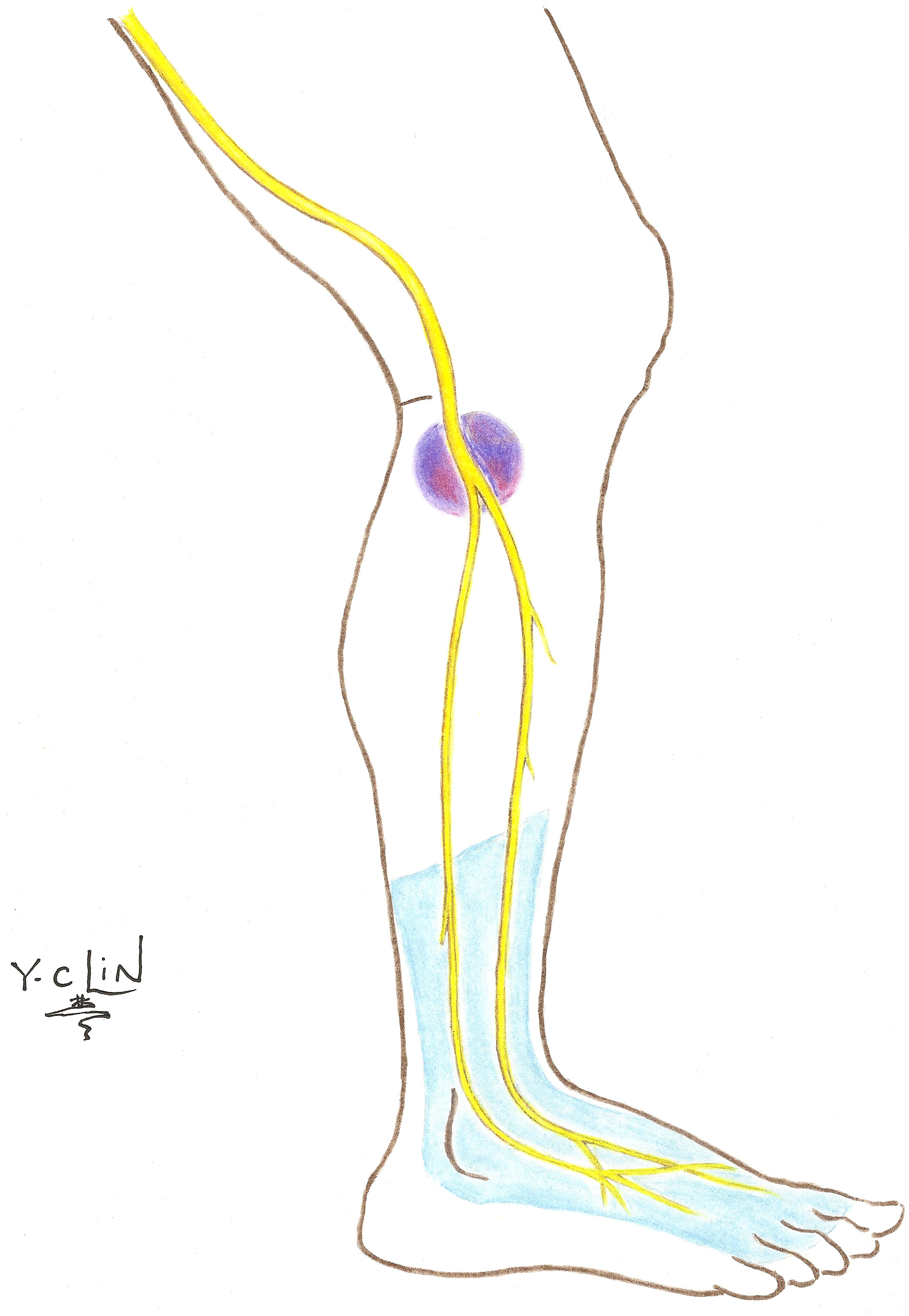 Conditions And Treatments | Brachial Plexus Program | Michigan Medicine ...